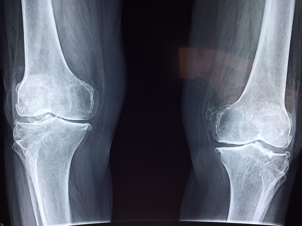 knee replacement cost