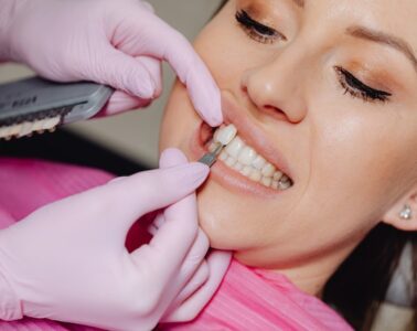 how much are veneers