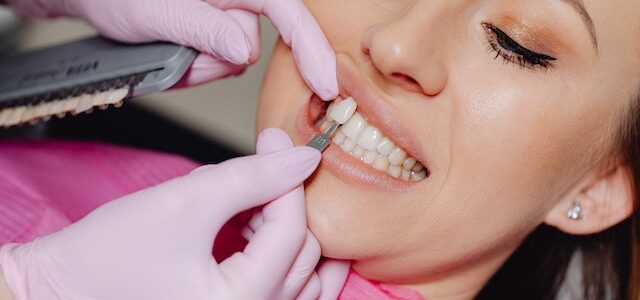 how much are veneers